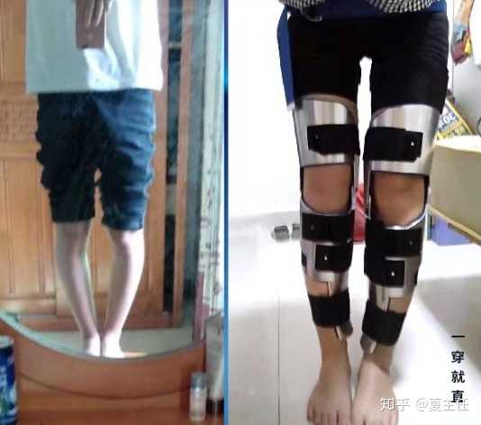 o型腿矫正手术价格,O型腿矫正手术价格指南